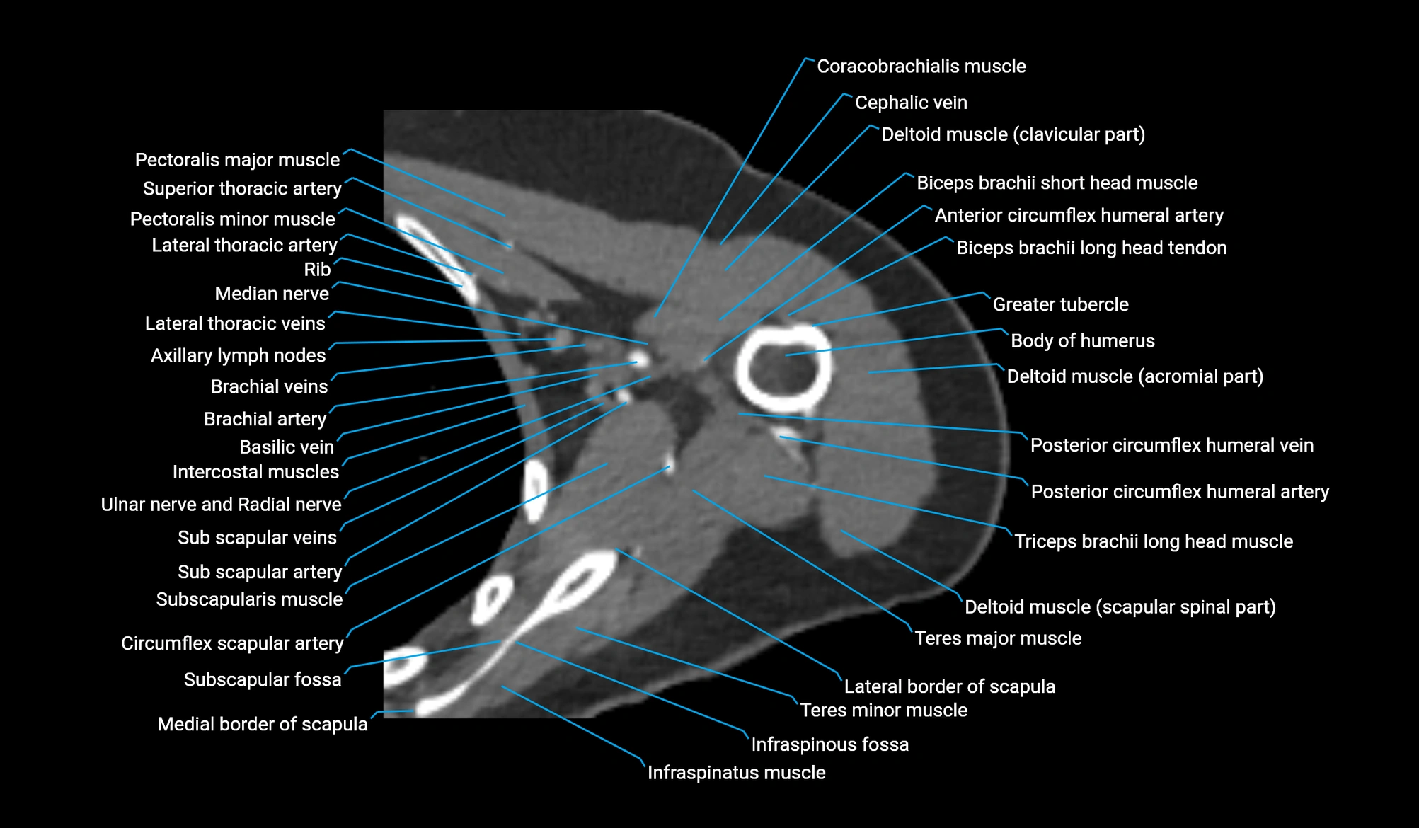 CT upper arm axial  cross sectional anatomy labelled radiology image -00130.webp